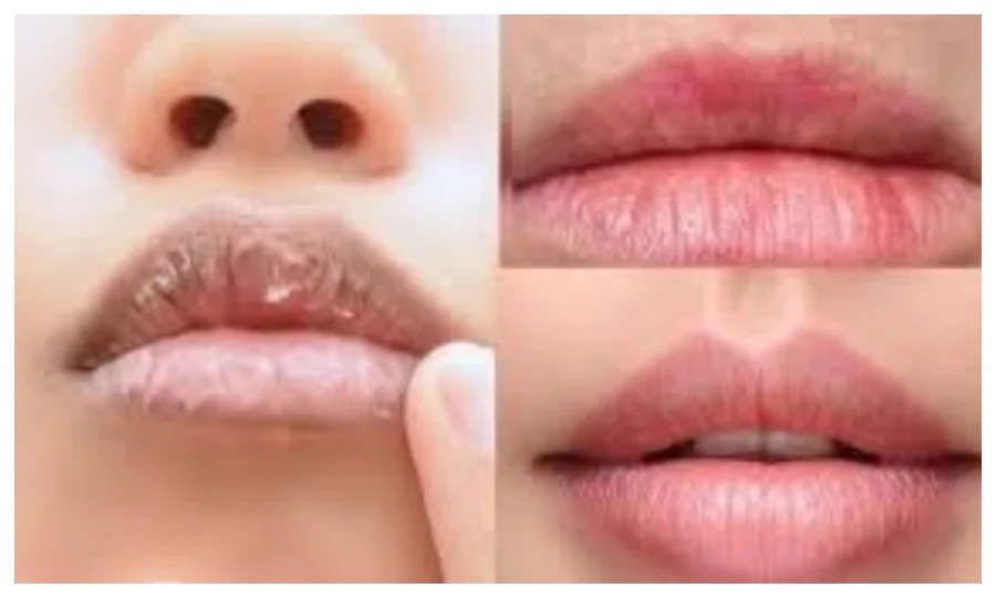 سردیوں خشک ہونٹوں کے مسئلے سے کیسے نمٹا جائے،ماہرین صحت نے بتادیا